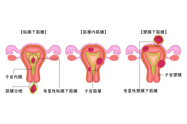 子宮筋腫