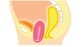 子宮脱