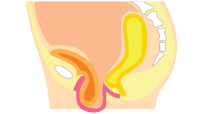 腟断端脱